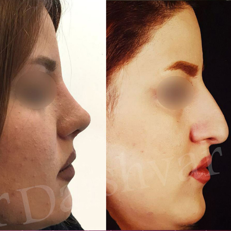 درباره جراحی بینی