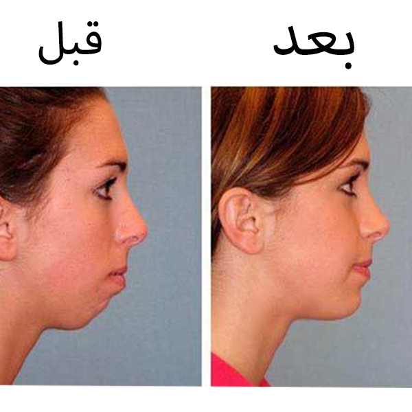 همه چیز درباره جراحی پروتز چانه