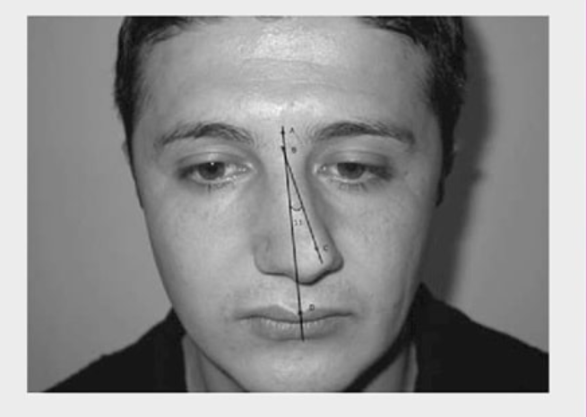 علت کج شدن بینی بعد از عمل