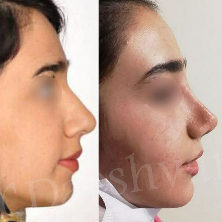 سوالات متداوم بعد از جراحی بینی 