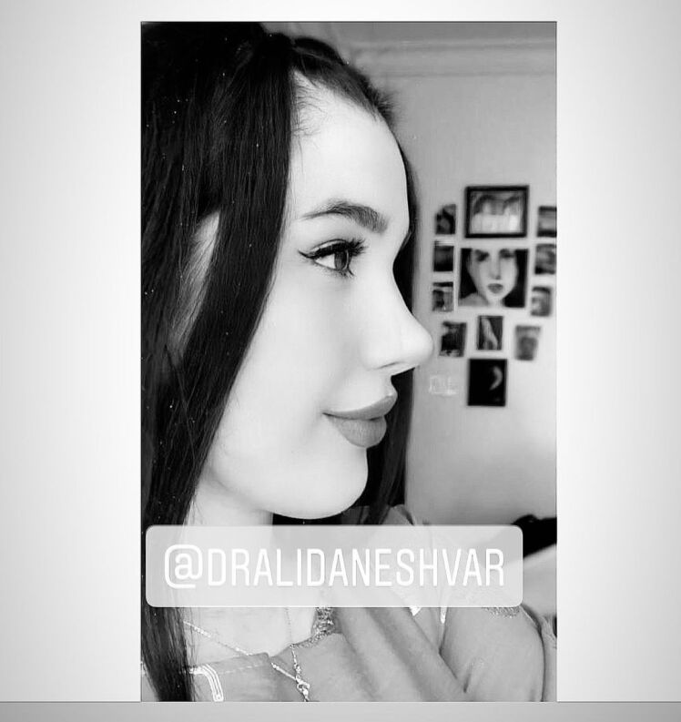 هر آنچه درباره جراحی بینی بدون بیهوشی باید بدانید!